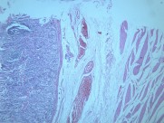 慢性萎缩性胃炎大全