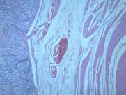 慢性萎缩性胃炎大全