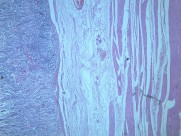 慢性萎缩性胃炎大全