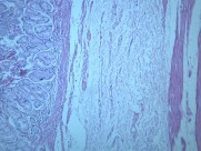 慢性萎缩性胃炎大全