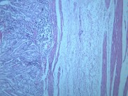 慢性萎缩性胃炎大全