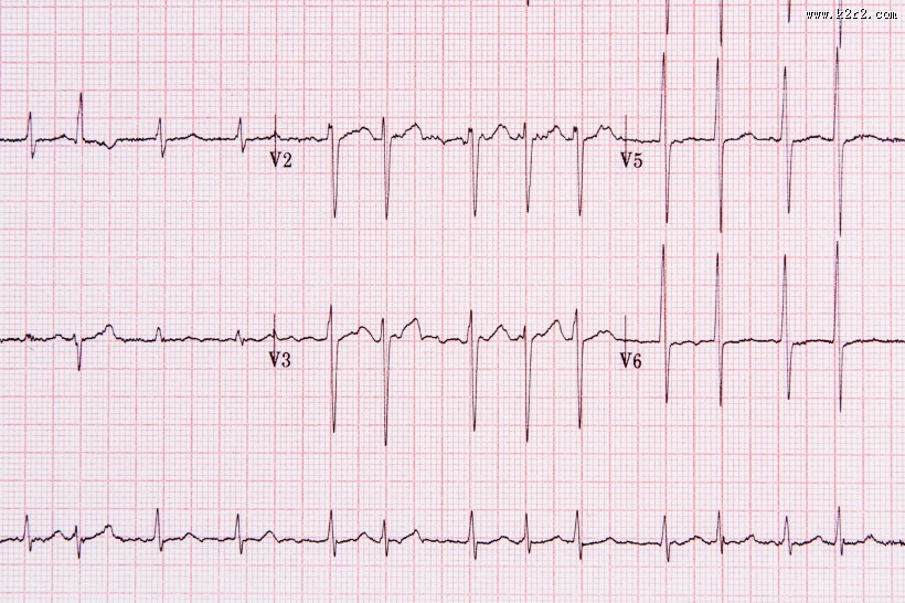 心电图图片大全