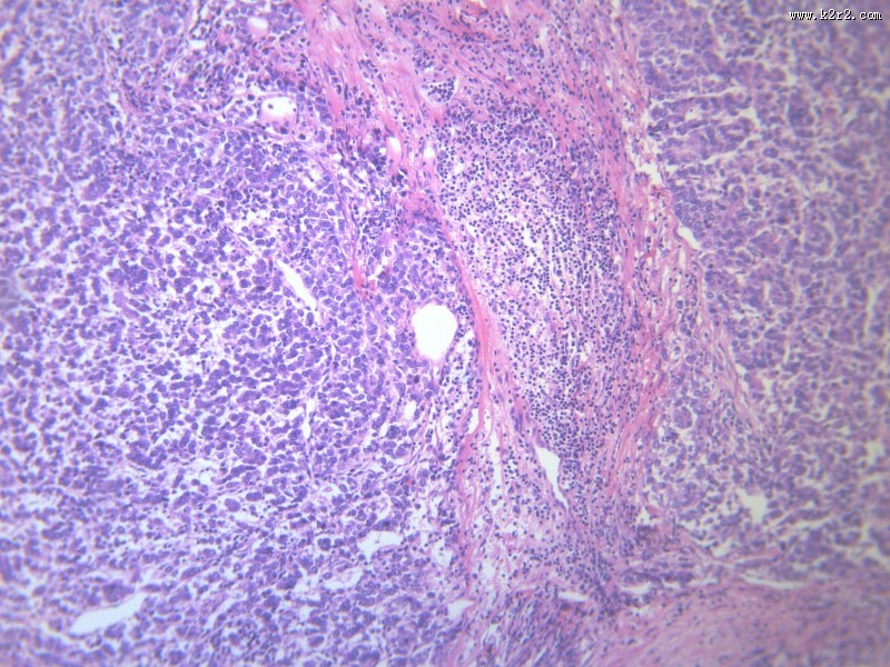 淋巴结内转移癌