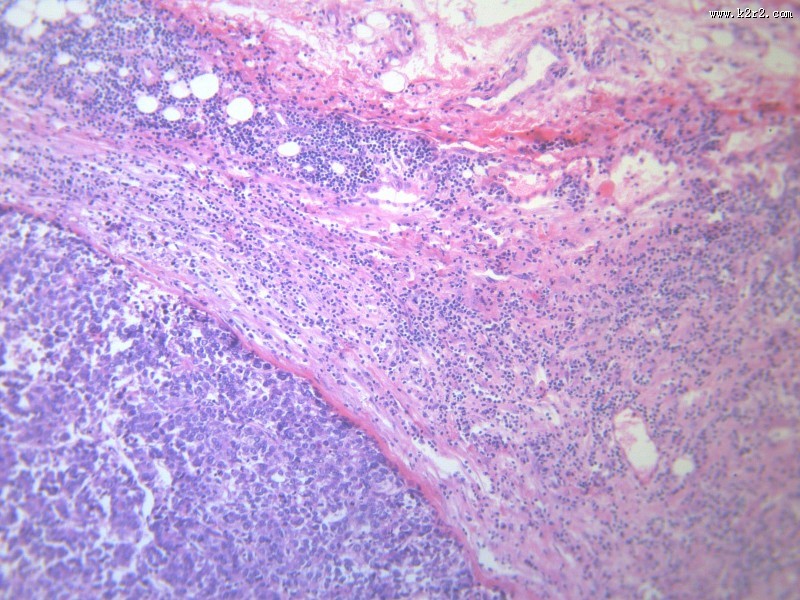 淋巴结内转移癌