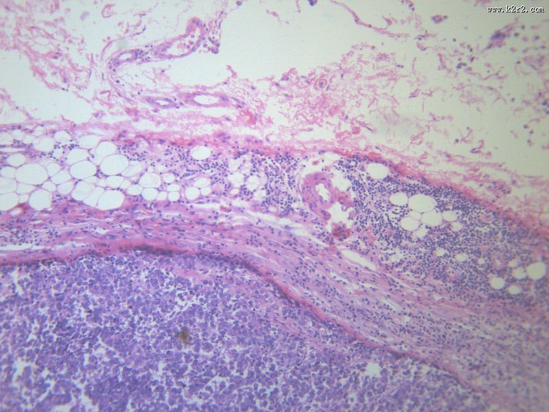 淋巴结内转移癌