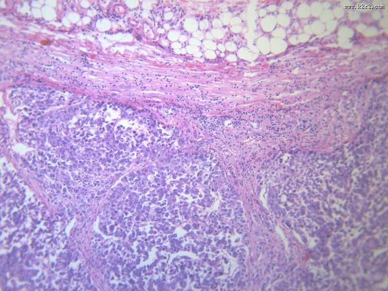 淋巴结内转移癌