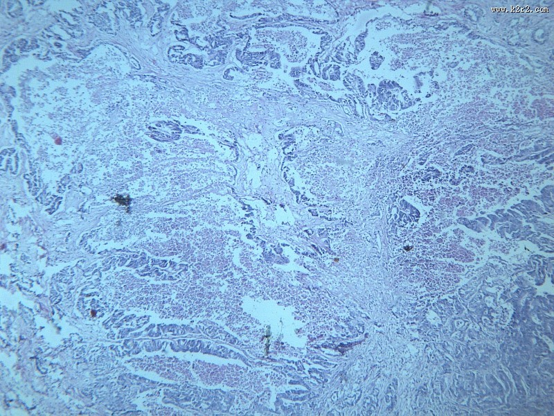 腺癌肝转移大全