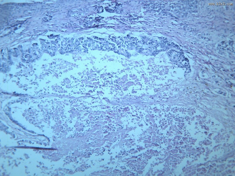腺癌肝转移大全