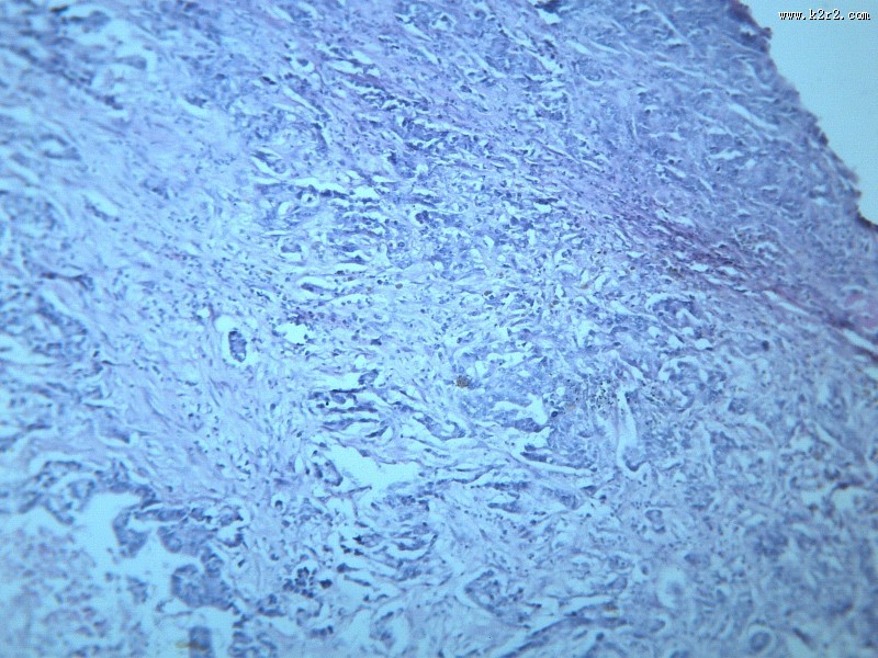 腺癌肝转移大全