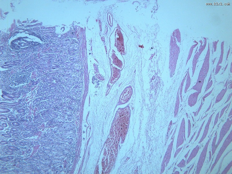 慢性萎缩性胃炎大全