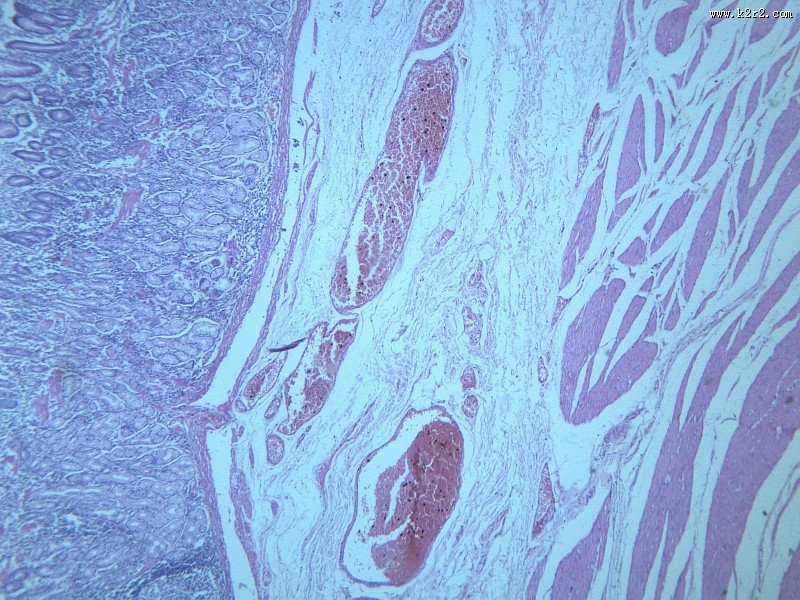 慢性萎缩性胃炎大全