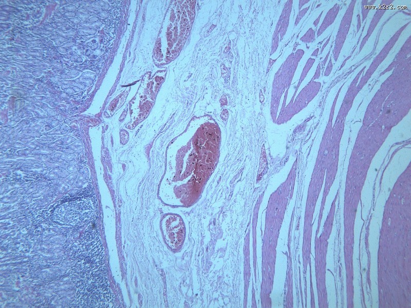 慢性萎缩性胃炎大全