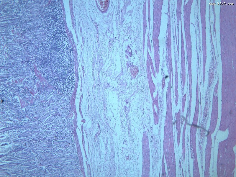 慢性萎缩性胃炎大全