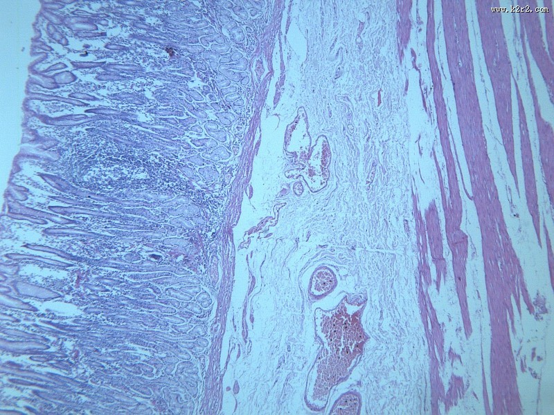 慢性萎缩性胃炎大全