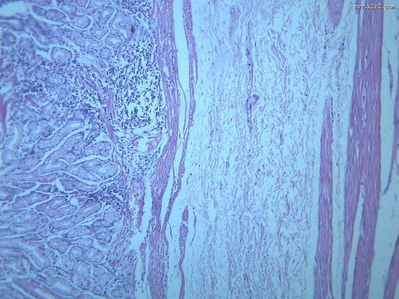 慢性萎缩性胃炎大全