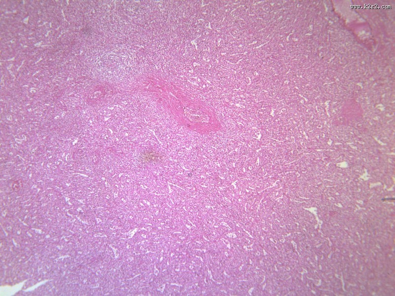 脾被膜玻璃样变