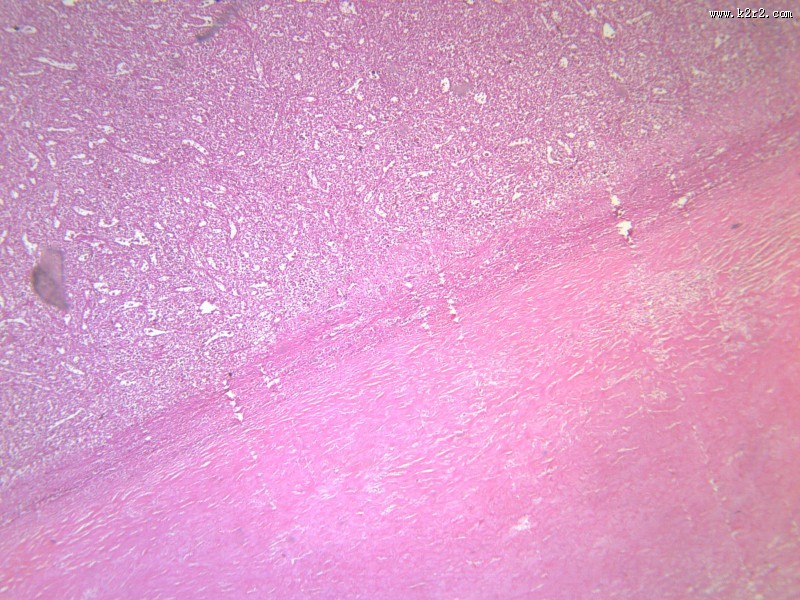 脾被膜玻璃样变