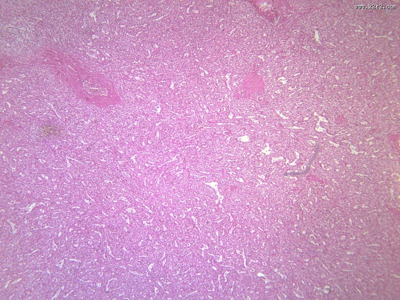 脾被膜玻璃样变