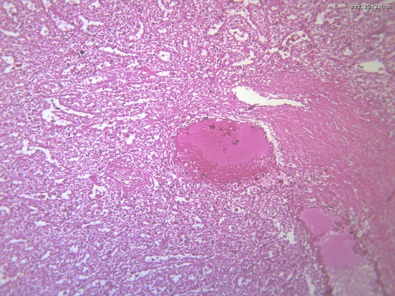 脾被膜玻璃样变